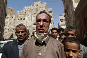 A Yemeni wounded man walks on a street following air strikes carried out by the Saudi-led coalition in the Al-Falihi neighbourhood in Sanaa's old city, on September 19, 2015. Air raids by Saudi-led coalition warplanes killed 15 people in Yemen's capital in one of the heaviest nights of bombardment in months, aid workers and witnesses said.    AFP PHOTO / MOHAMMED HUWAIS